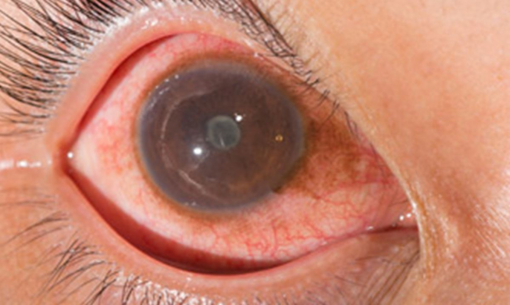 What Are Uveitis And Its Causes RYTE News   Untitled1 1 1024x614 